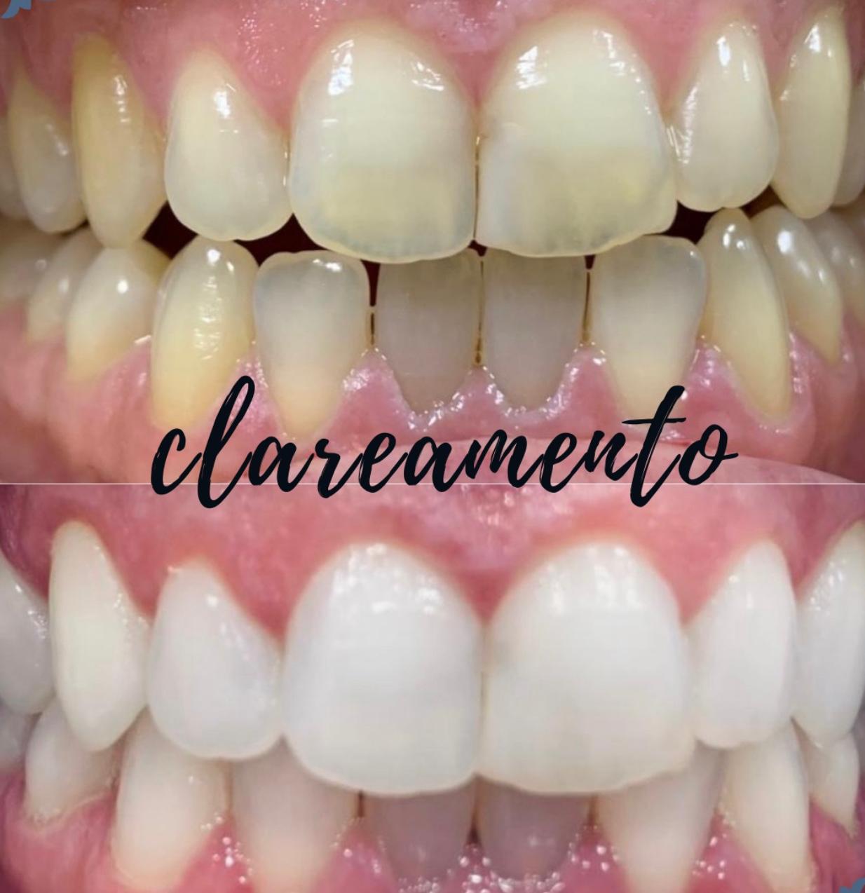 Clareamento Dental — Dr. Giuliano de Pádua