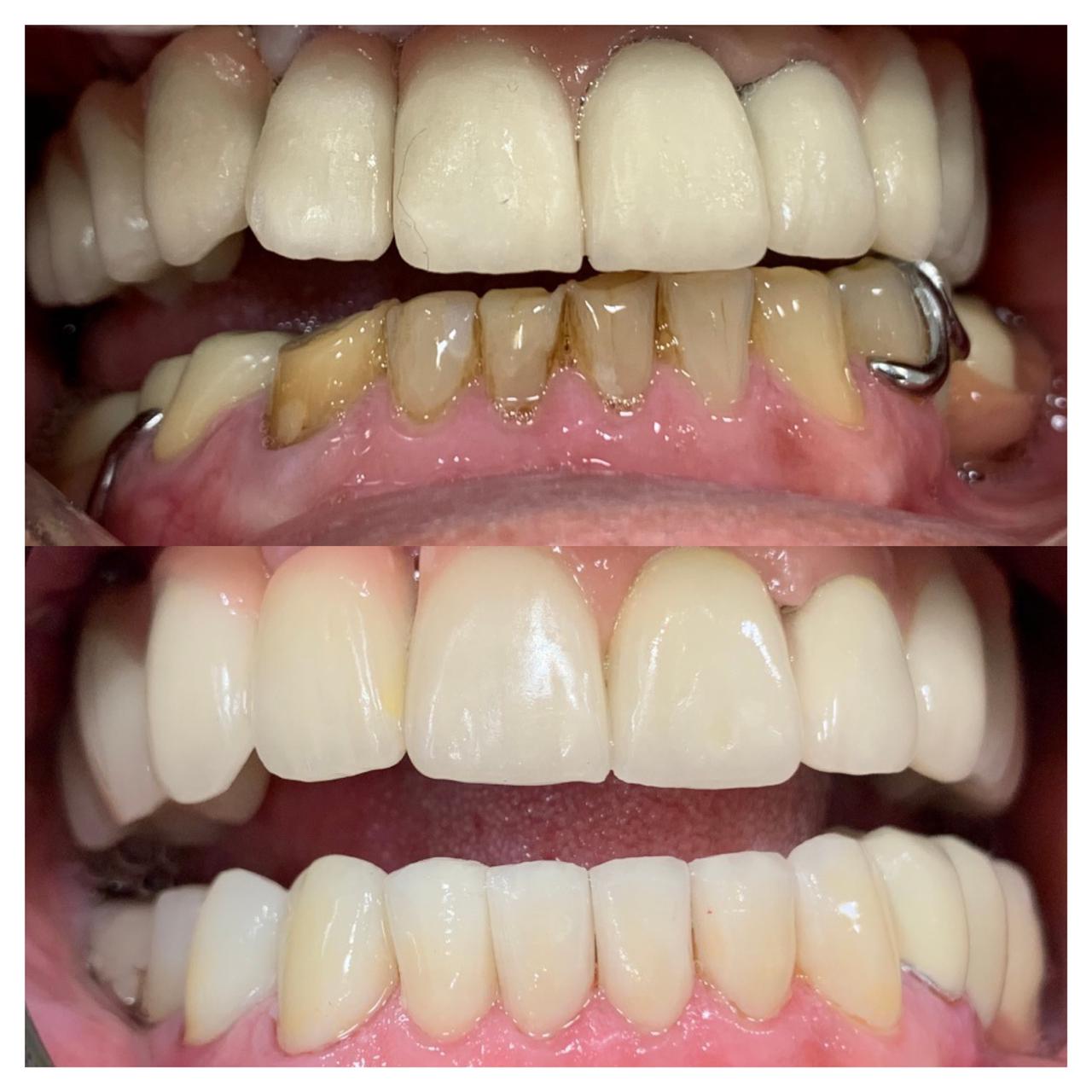 Implantes - Dr. Giuliano de Pádua