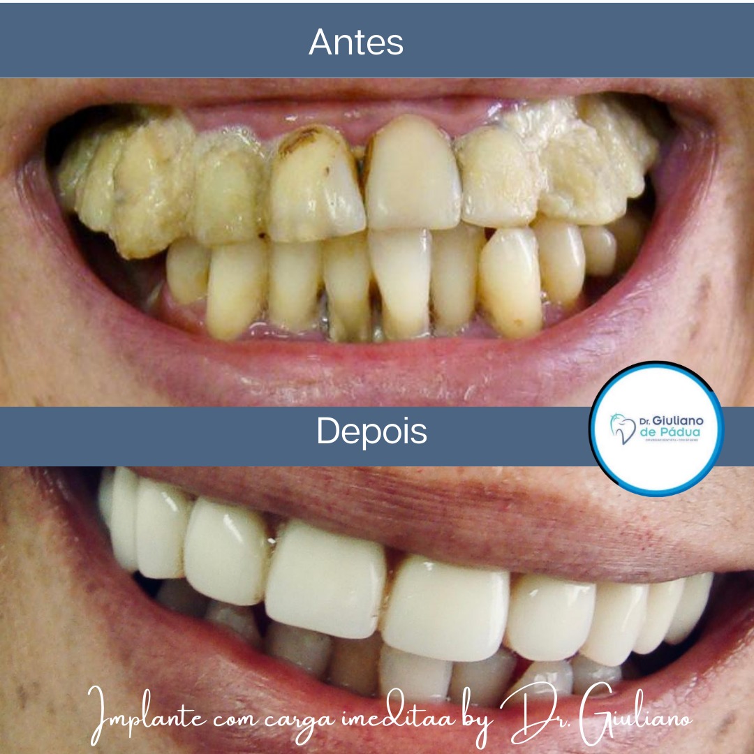 Implantes — Dr. Giuliano de Pádua