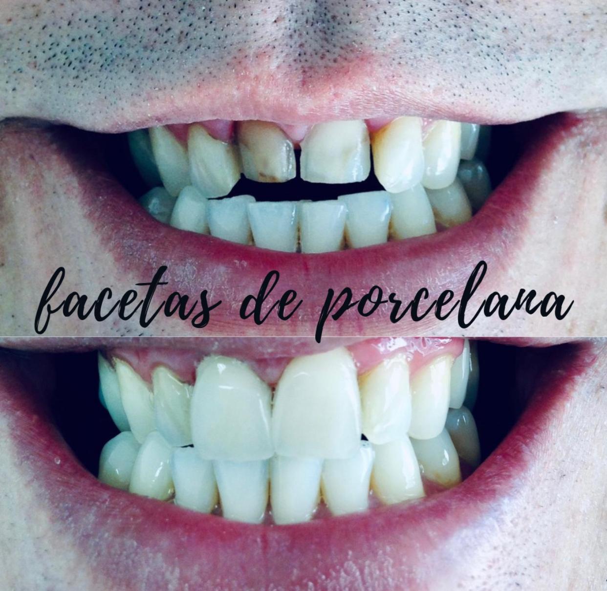 Lentes de Contato e Facetas — Dr. Giuliano de Pádua