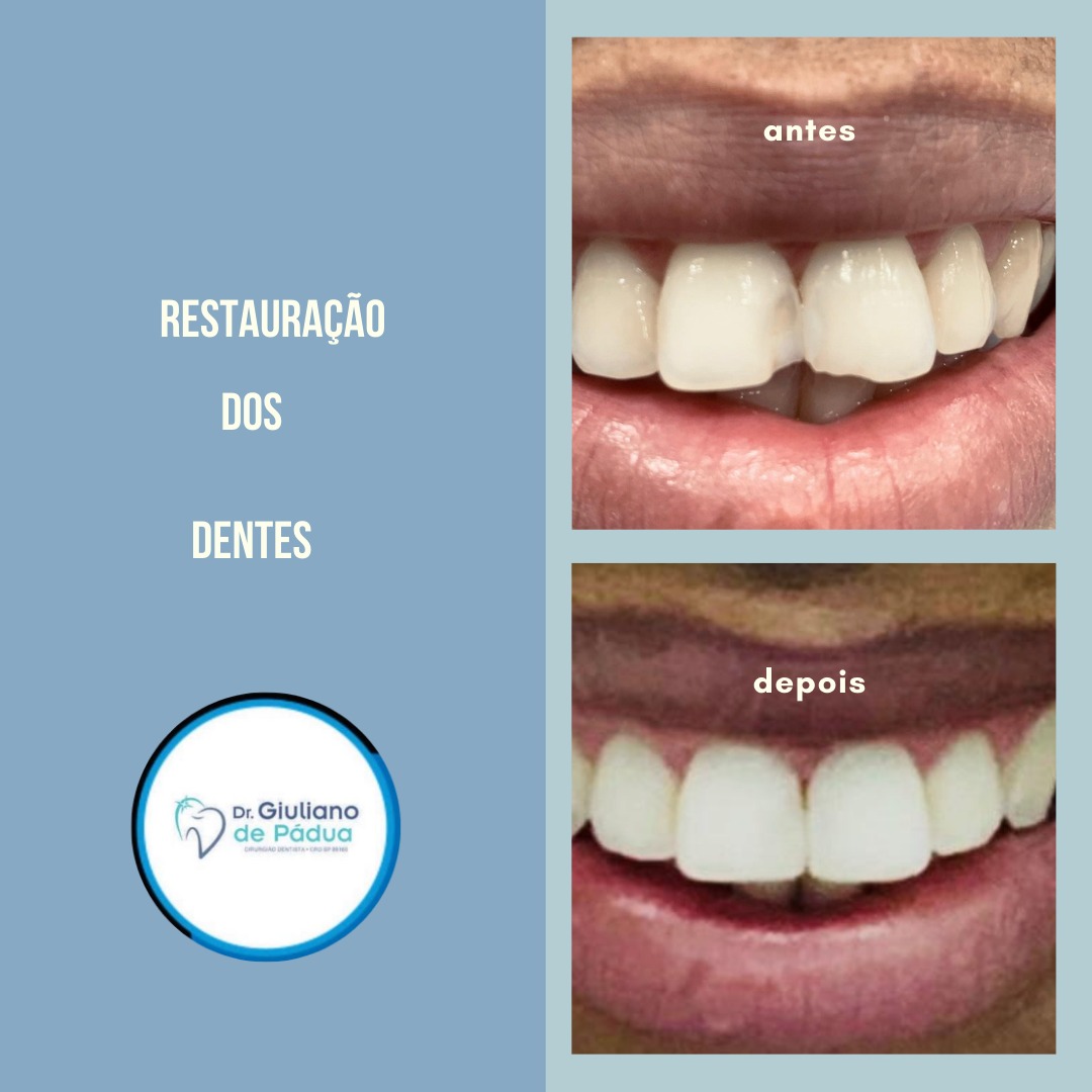 Tratamento Periodontal — Dr. Giuliano de Pádua